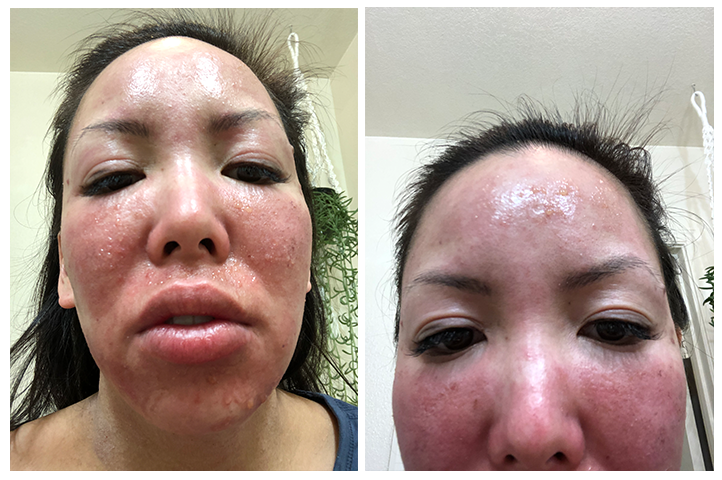 I got a chemical burn on my face from essential oils | by Eva | Medium