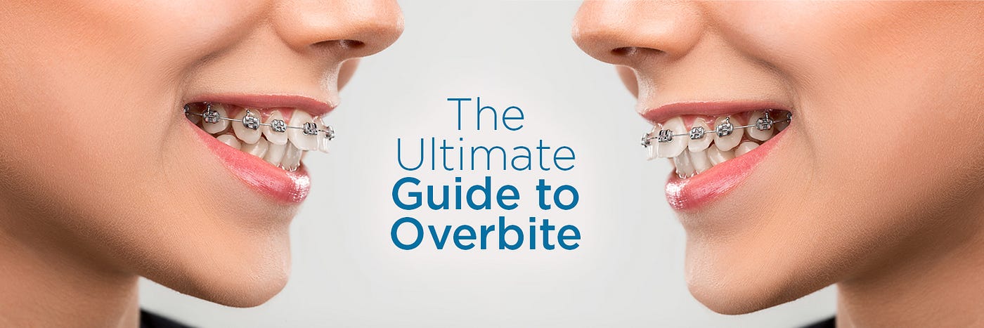 What Is an Overbite and How Can It Be Fixed?