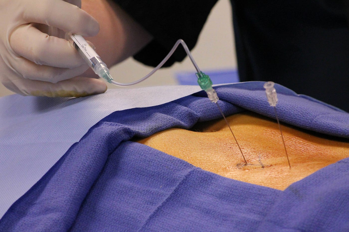 Efficacy of Epidural Steroid Injections for Treating Lower Back Pain, by  Dr. Luis Fandos-NY