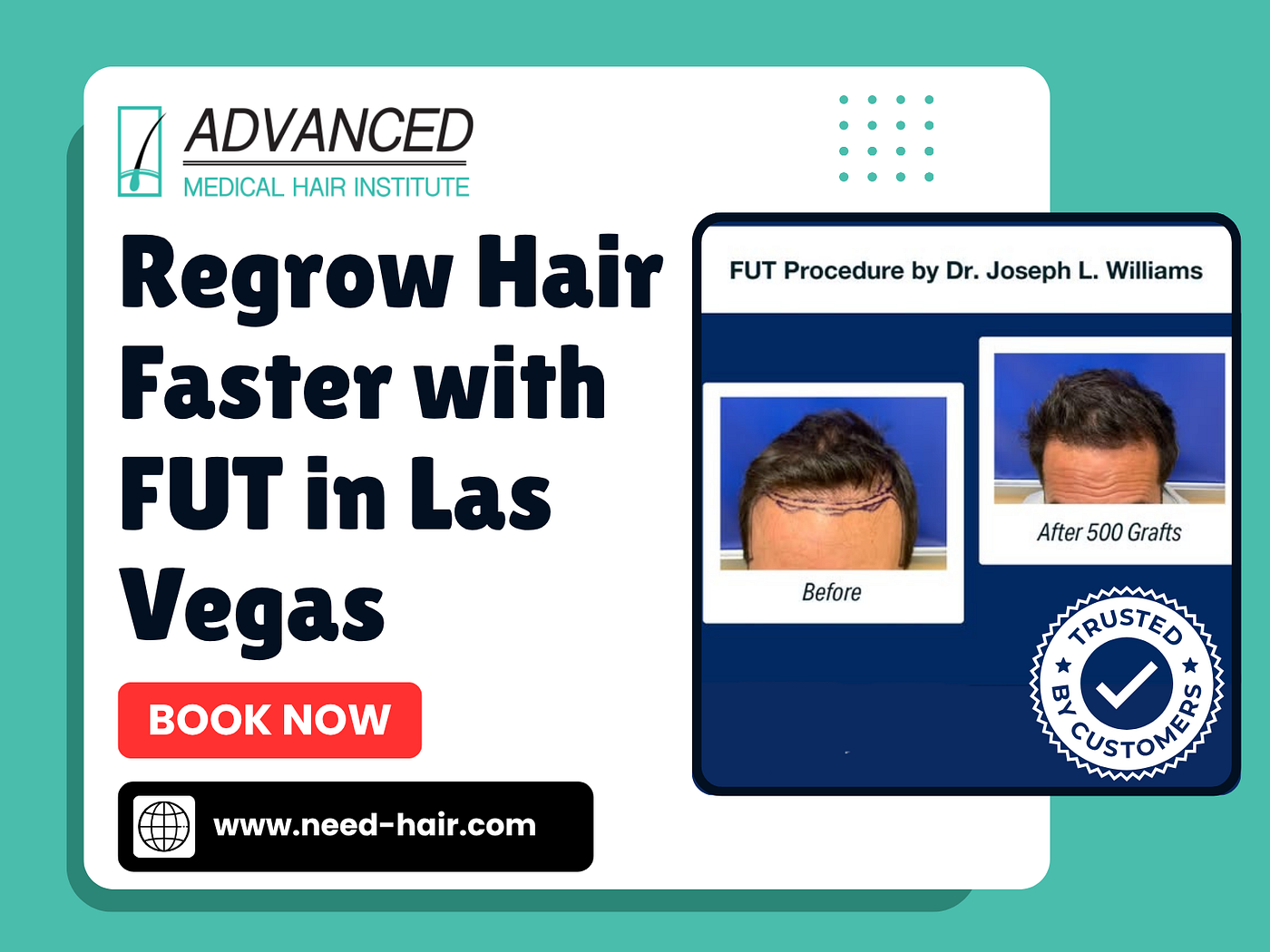 FUT Hair Transplant in Las Vegas | Personalized Hair Restoration