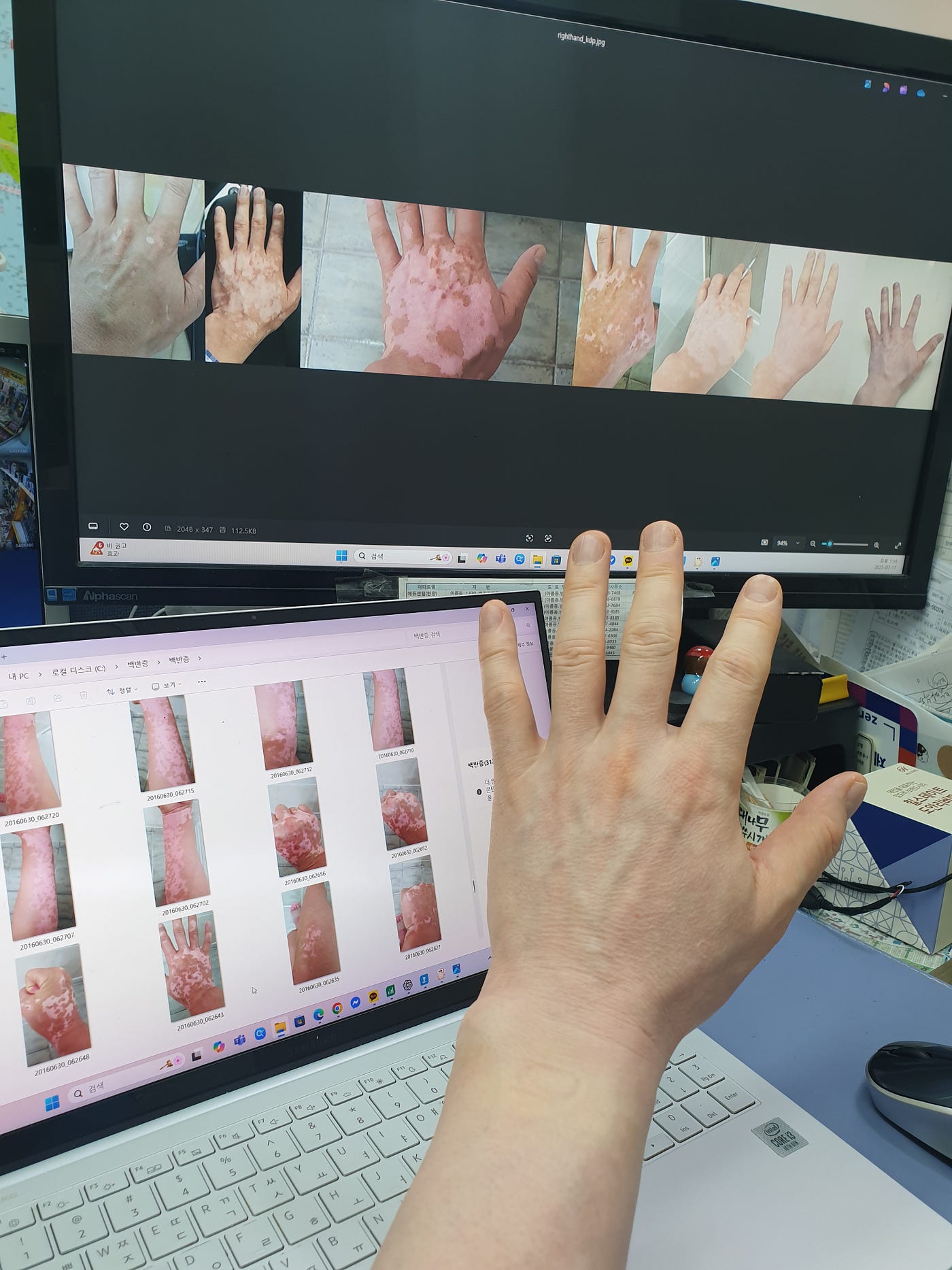 Why a 12-Year Vitiligo Dataset Was Recognized by AI — But Missed by Humans