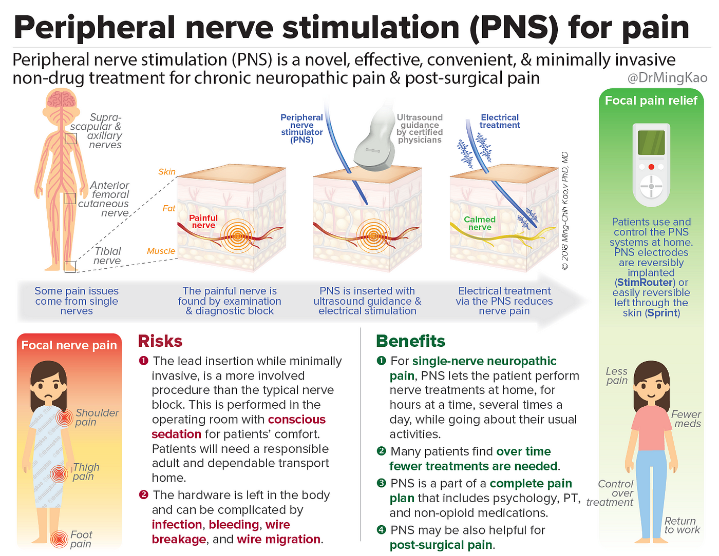 Peripheral Nerve Stimulators: Drug-Free, Low-Back Pain Relief