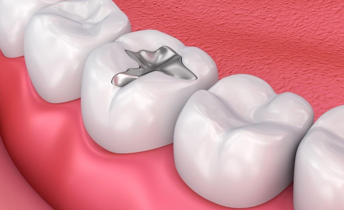 dental filling in Nayapalli