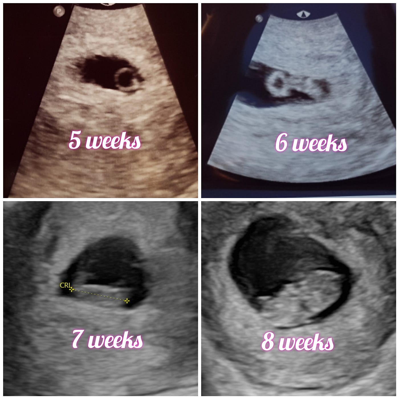 Donor egg diary weeks 6–9. Week 6, where to start… | by Becca | Medium