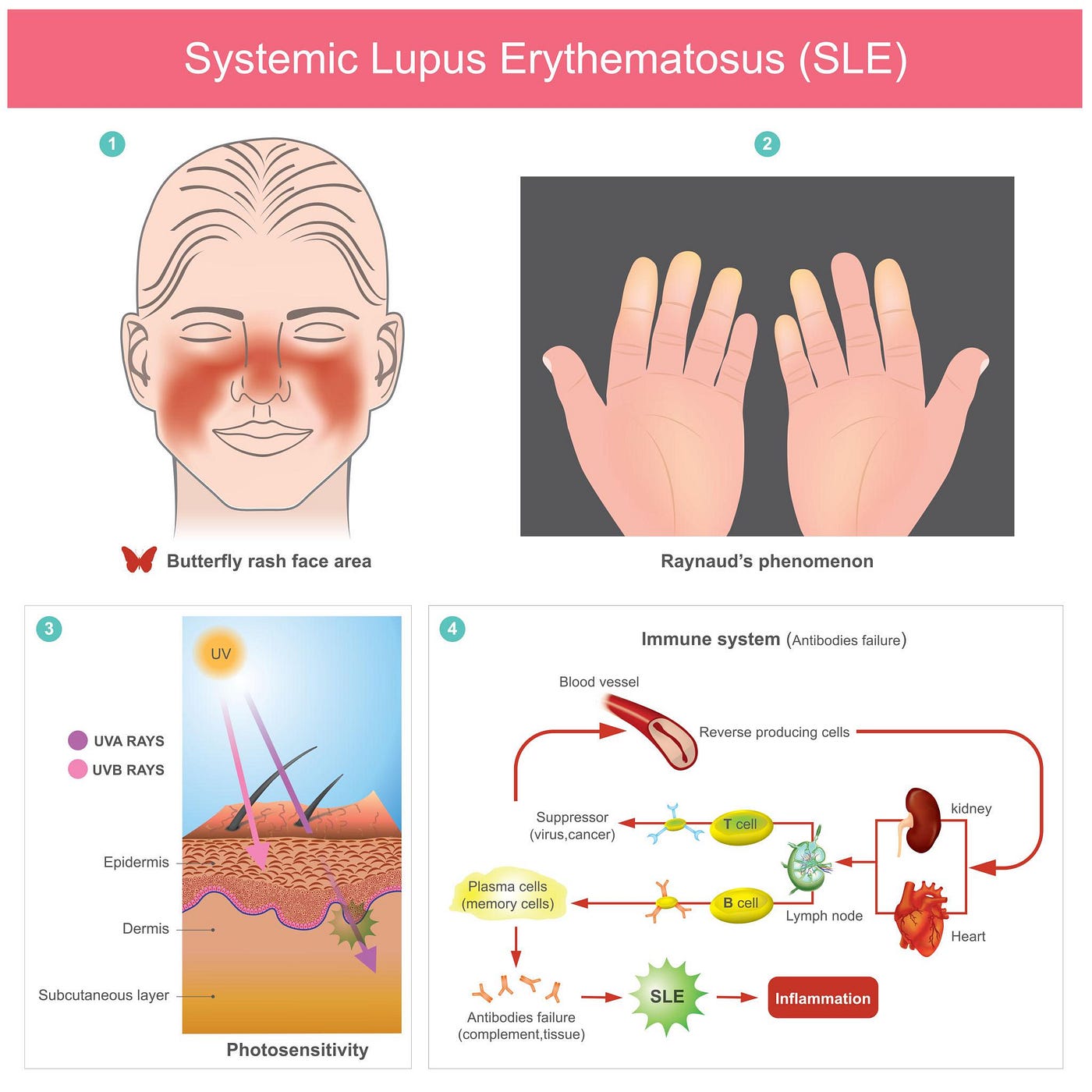 SLE: the Invisible autoimmune battle