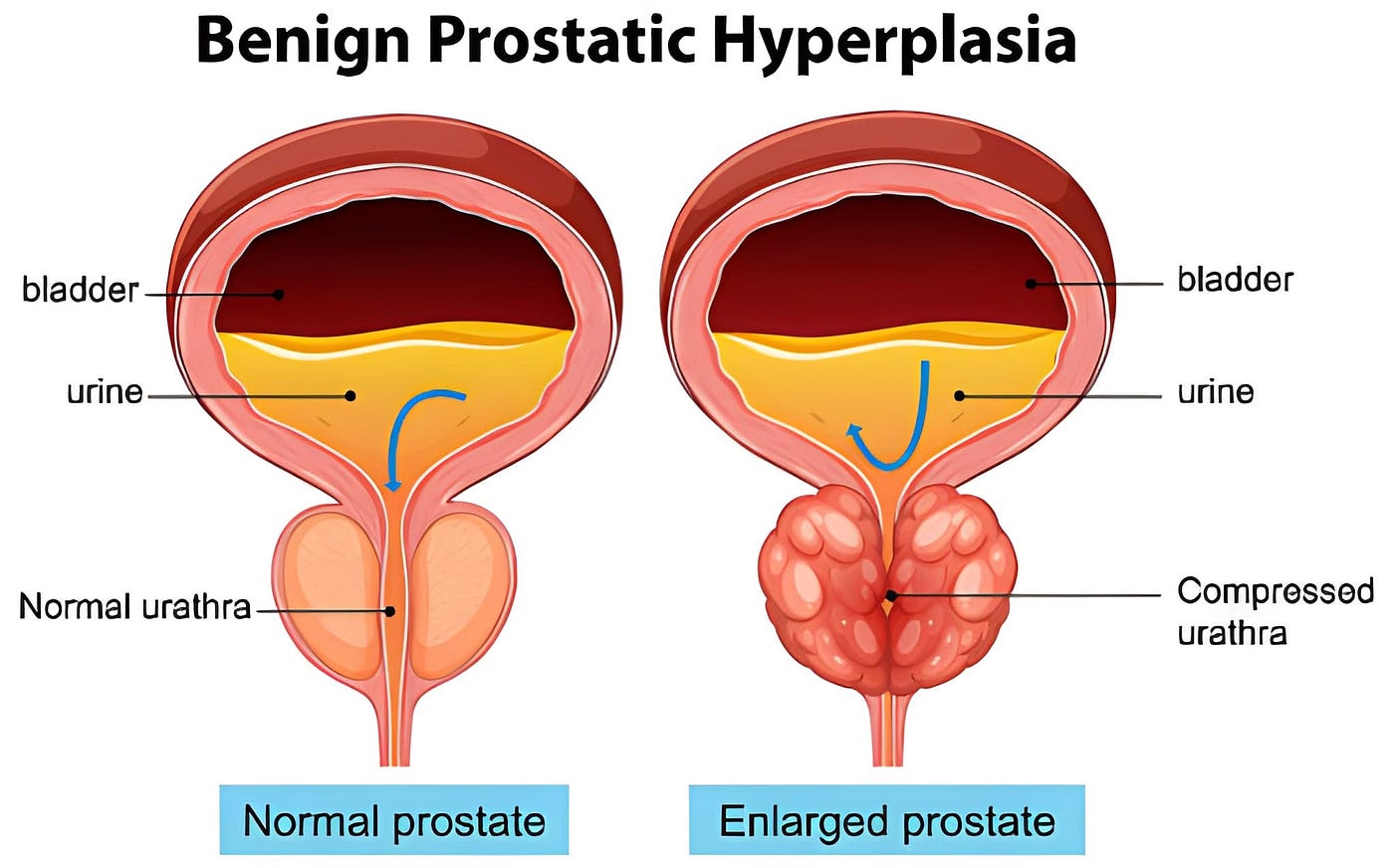 7 Warning Signs of an Enlarged Prostate (BPH) + Early Symptoms Every Man Should Know