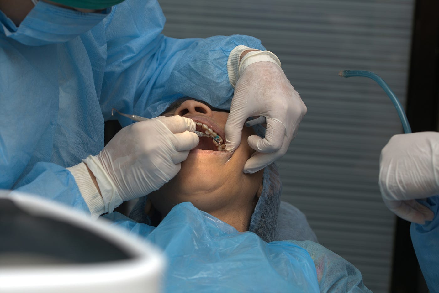 Pulpotomy vs Root Canal: Key Differences Explained
