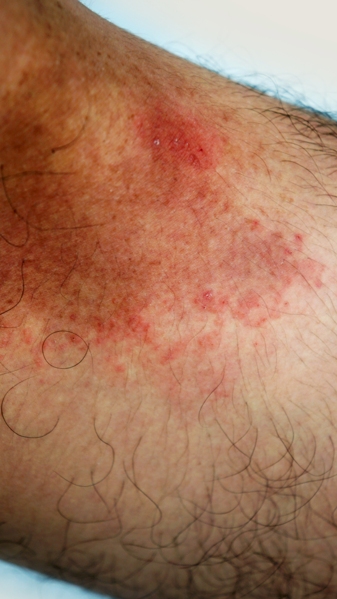 How to treat “tinea” fungal infections ?, by Teja V Surapaneni, MD, MS, YourMD.online, Jan, 2024