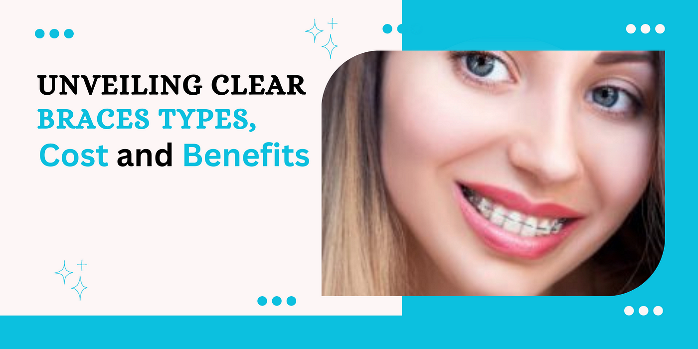 Clear Braces: All You Need to Know About Types, Costs, Benefits