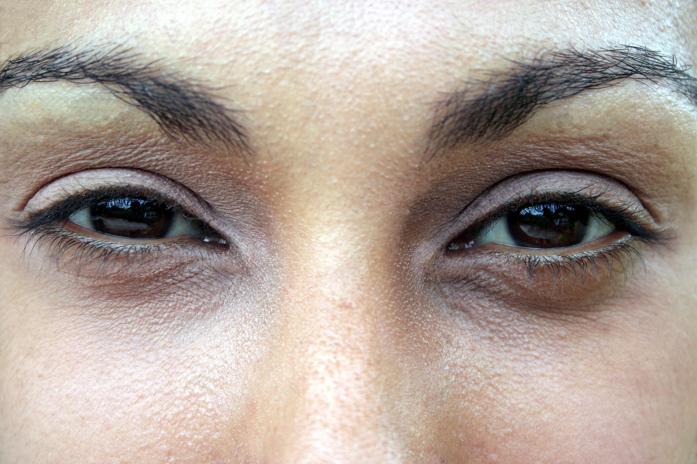 Dark Circles and Under-Eye Hollows