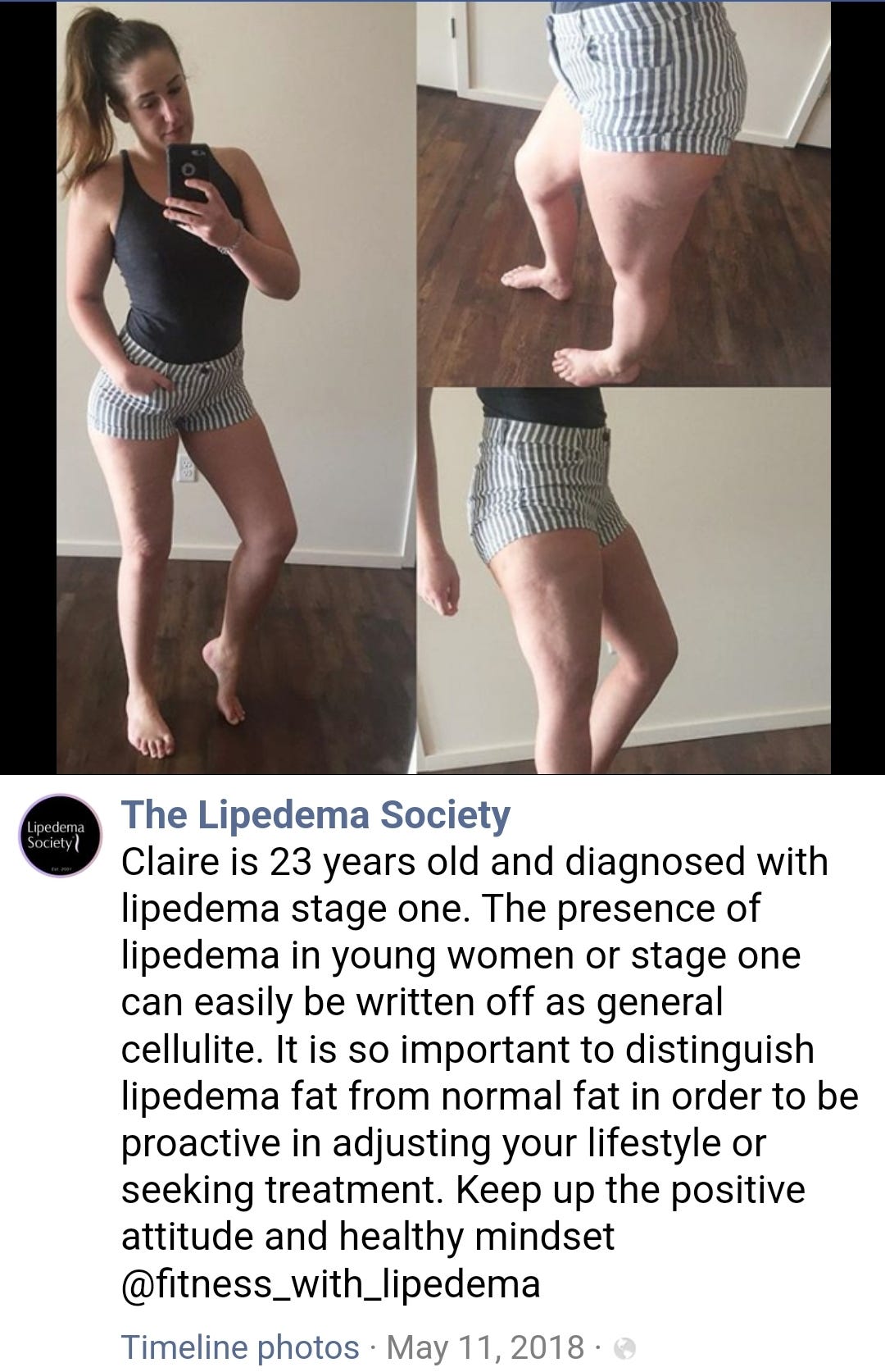 Thin Women Do Get Lipedema. Setting the record straight.