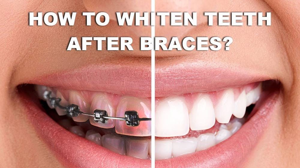 How To Get White Teeth With Braces? | by Dr. Sumit Sehgal General Dentist |  Radiant Star Dental Services | Medium