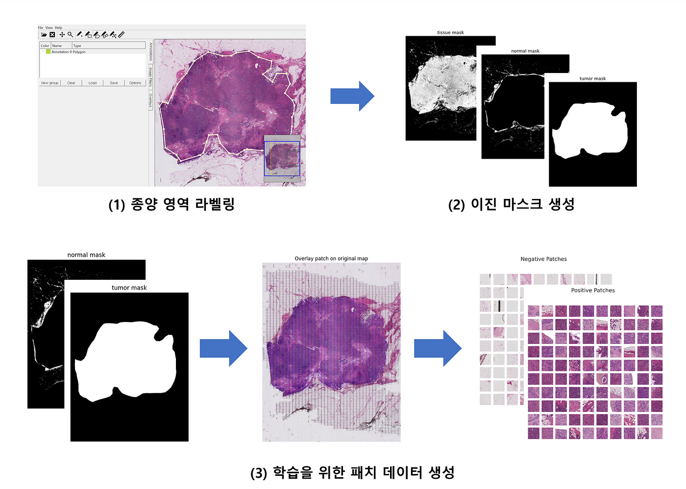 병리 슬라이드를 이용한 종양 탐지 AI 모델 개발