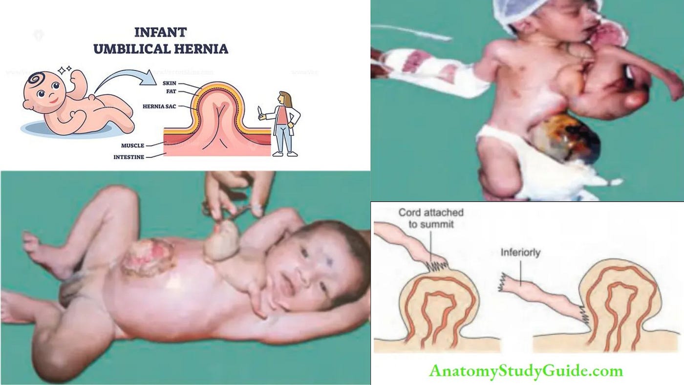 Umbilical Hernia Causes and Treatment