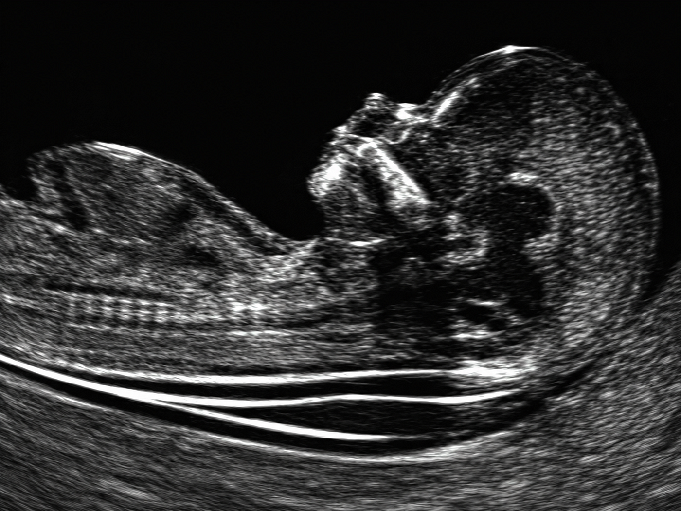 Pregnant and Feeling Anxious About Your Baby's Health? An NT Scan Can Help Provide Early Answers