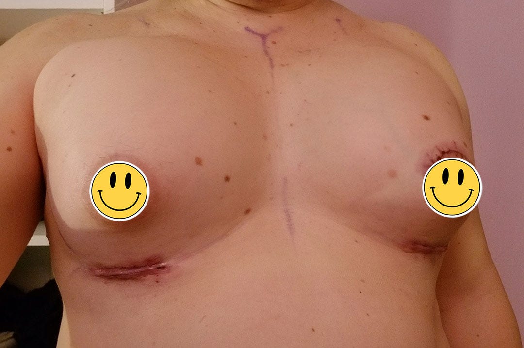 My New Boobs. A day-to-day account of my transgender…, by Cassie Brighter, Empowered Trans Woman