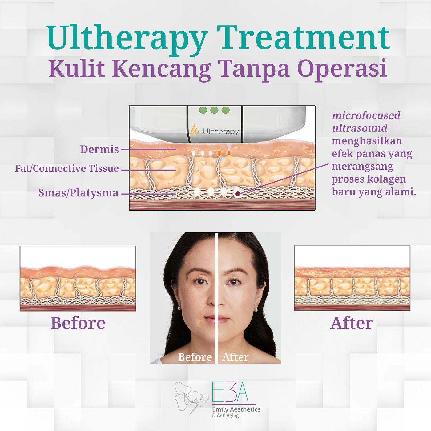Ultherapy - Facelift Tanpa Operasi Untuk Mengangkat Dan Mengencangkan Kulit Anda- E3A Klinik