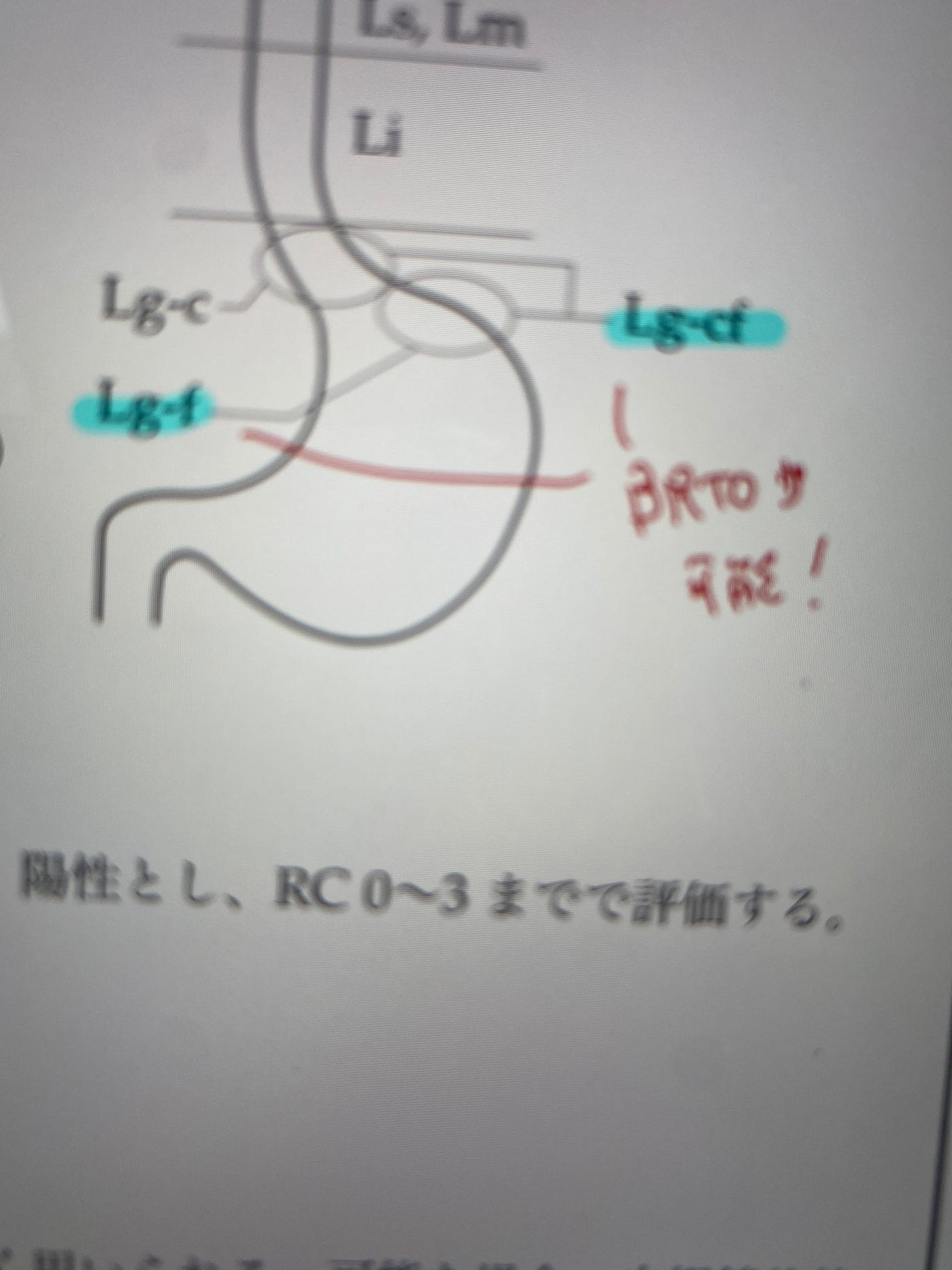 食道静脈瘤