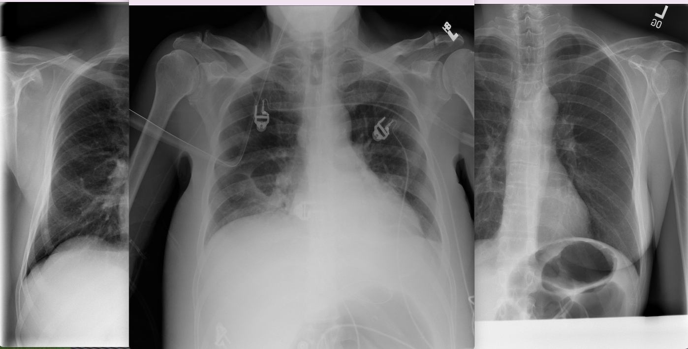 Heart Failure How Does It Appear On A Chest Xray?, 44 OFF
