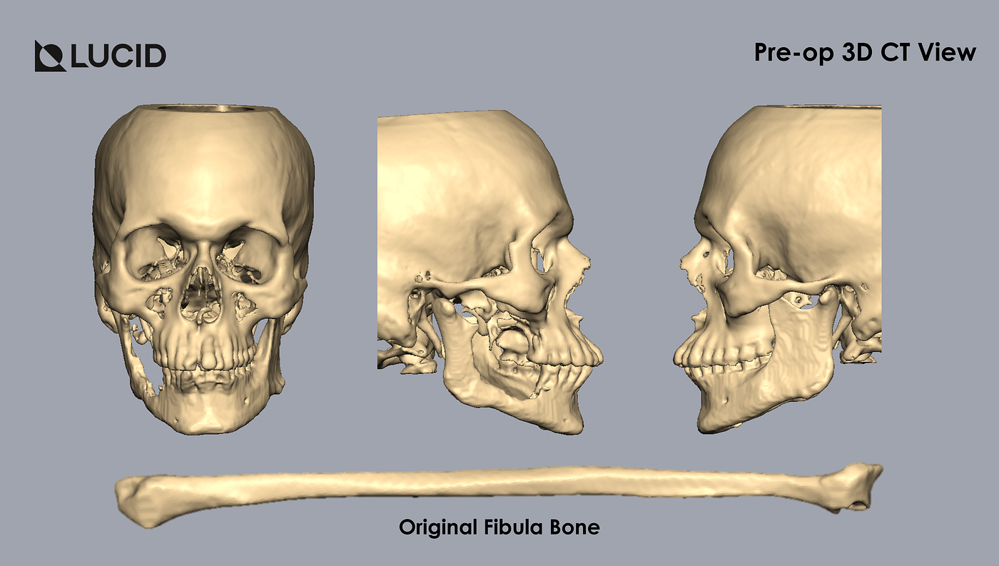 Microsurgical Jaw Reconstruction using Fibula Free Flap