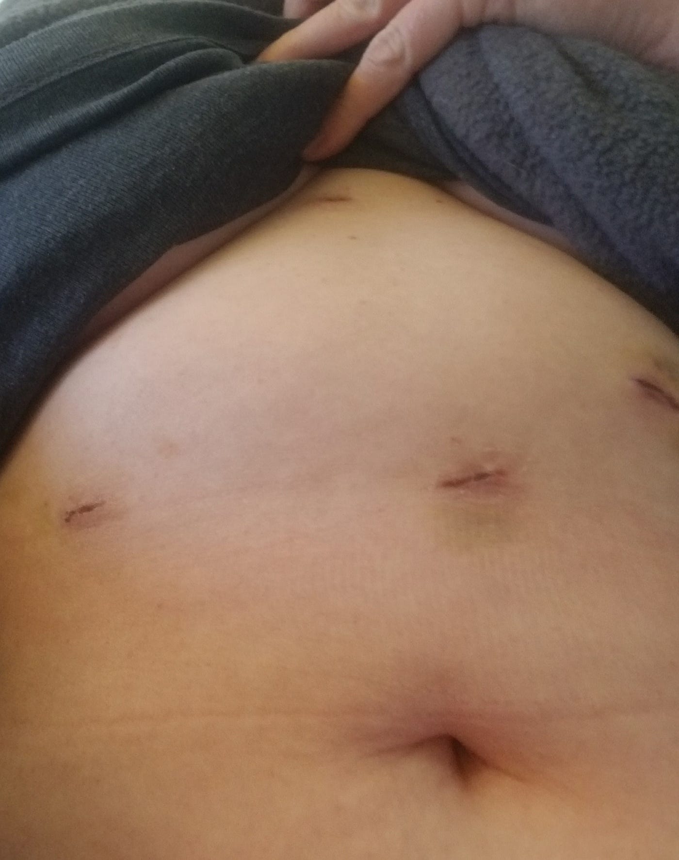 Hiatal Hernia Surgery: Recovery, Scars, and More