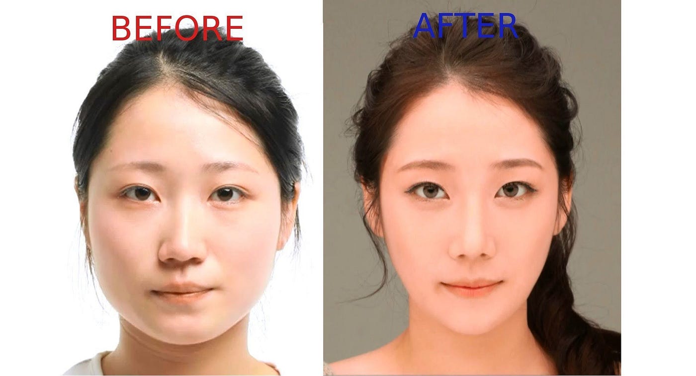 korean plastic surgery before and after gone wrong