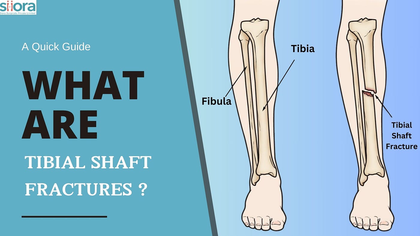What Are Tibial Shaft Fractures? A Quick Guide