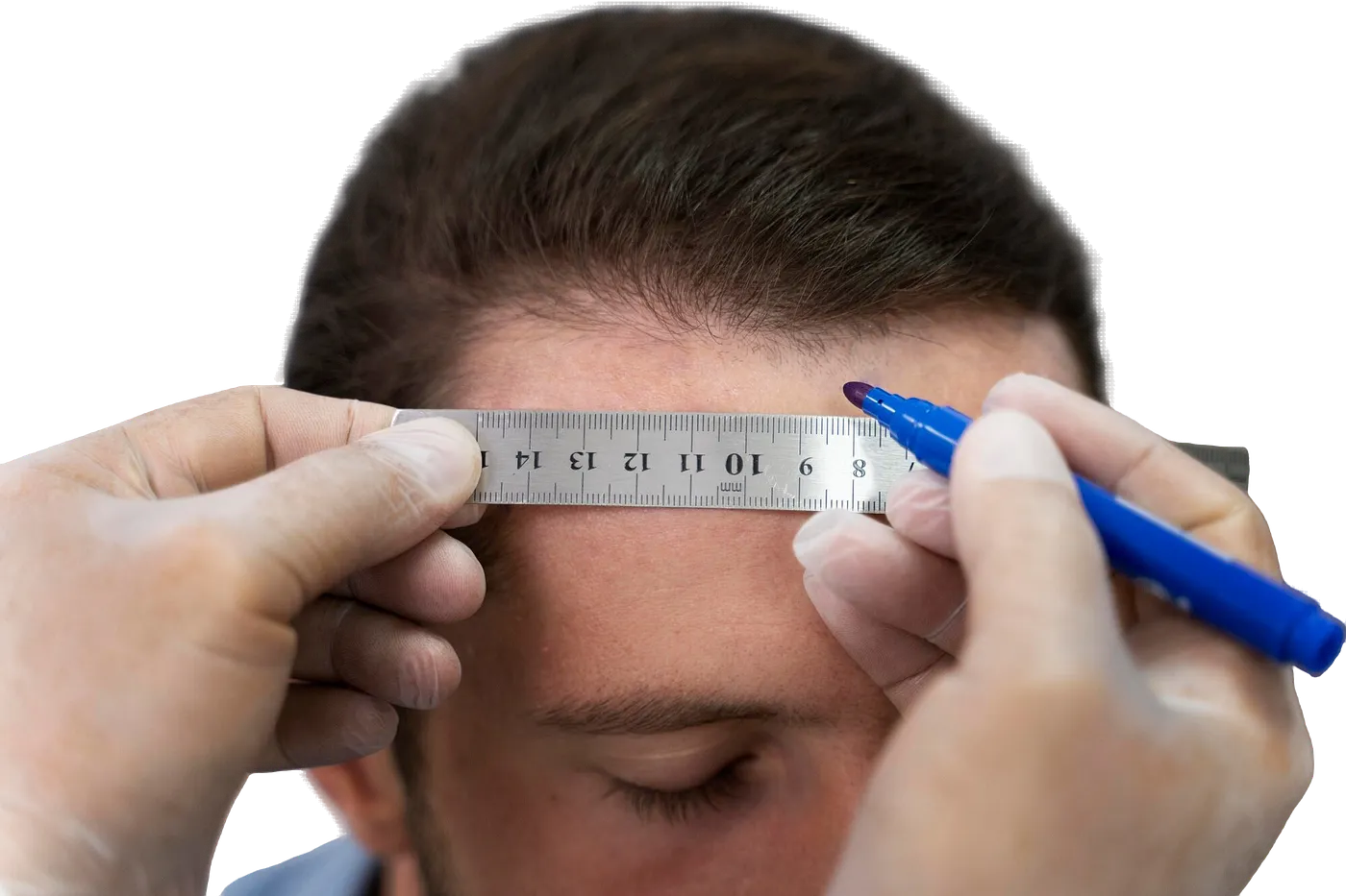 Best Hair Clinic in Coimbatore