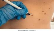 The Truth About Removing Skin Tags in One Night: Separating Fact from Fiction