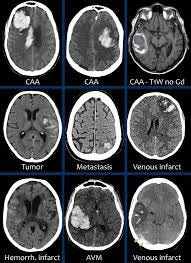 A brain hemorrhage, otherwise known as intracranial or cerebral hemorrhage, results from when a…
