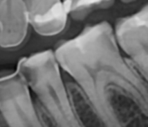 Three Hidden Cavities, Zero Extractions: A Same-Day Endocrown and Ceramic Inlay Case in Seoul
