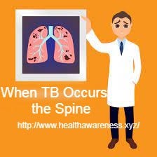 When TB Occurs in the Spine — healthawareness.xyz