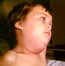 Child with Mumps