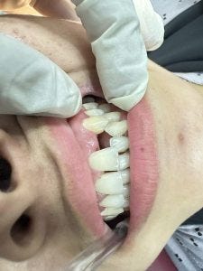 Dental Crowns before And After?