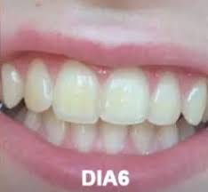 clareamento dental