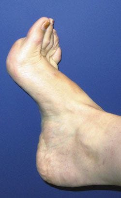 Dealing with Pes Cavus: Foot Support and Therapy Options