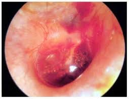 Barrett’s Esophagus: Memahami Kondisi, Risiko, dan Cara Menanganinya