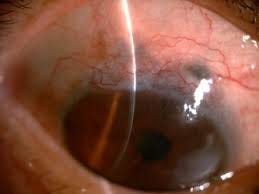 Managing a Diffuse Low-Lying Bleb: A Practical Approach