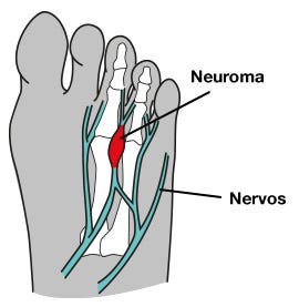 Neuroma de Morton: o que é e como tratar | by Pés Sem Dor | Medium