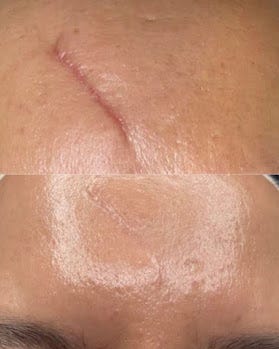 CAN MICRONEEDLING MAKE HYPERPIGMENTATION WORSE?