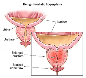Benign Prostatic Hyperplasia Treatment in India : Effective Solutions