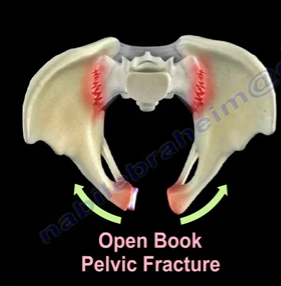 What are open book pelvic fractures?