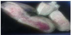 Study of the different types of digestive lesions: Epidemiological and histopathological aspects