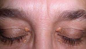 Xanthelasma Removal: Get Clearer Skin at Eyes Defined Clinic in London