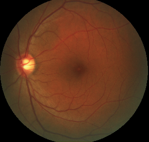 Eye image from the AMD dataset