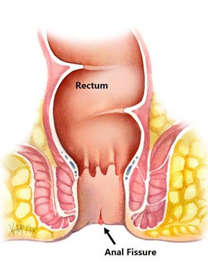 How Surgery Helps Heal a Painful Anal Cut (Fissure)
