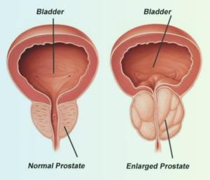 Benign Prostatic Hyperplasia Medication — https://health-news-reports.com/