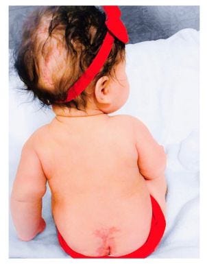 Spina Bifida Awareness: Early Detection and Care