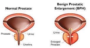 Prostate Enlargement Treatment: Follow Modern Treatment Procedure for the Most Effective Solution