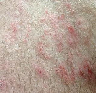 Eczema Treatment in Houston